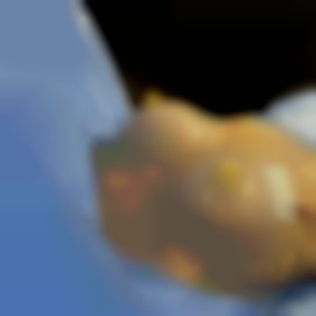 мамопластика