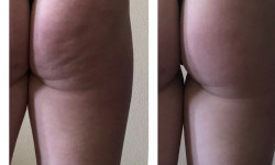 Антицелюлітний масаж Масажист  Київ