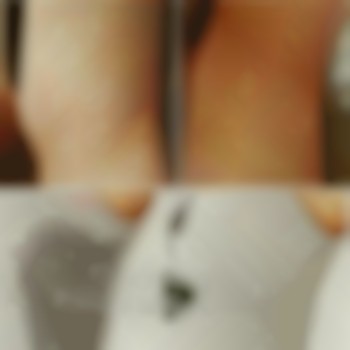 Лікування гіпергідрозу.