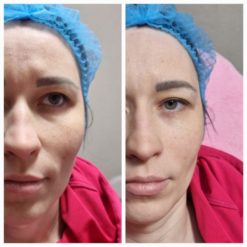 ПЛЛА Полімолочна кислота, фото - Лікар-косметолог Лілія Миколаївна