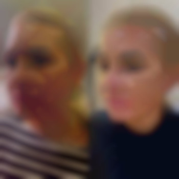 ПЛЛА, фото - лікар-косметолог Лілія Миколаївна