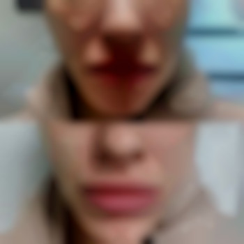 Корекція носогубних складок, фото - лікар-косметолог Лілія Миколаївна