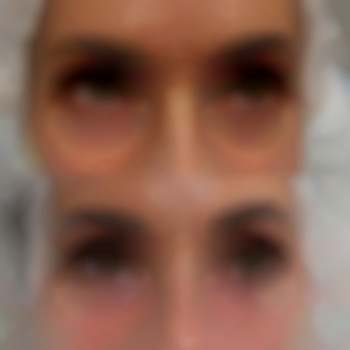 Корекція нососльозної борозди, фото - лікар-косметолог Лілія Миколаївна