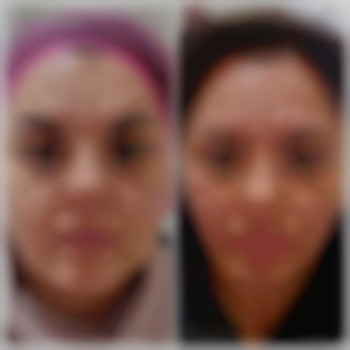 Ліполітик, фото - лікар-косметолог Лілія Миколаївна