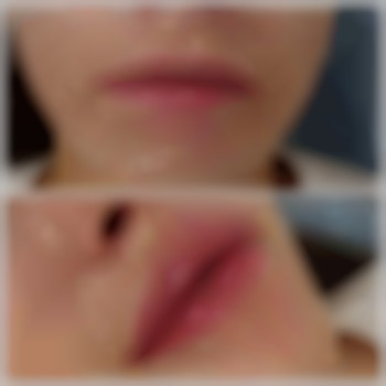 Аугментація губ, фото - лікар-косметолог Лілія Миколаївна