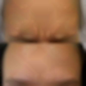 Ботокс, фото - лікар-косметолог Лілія Миколаївна