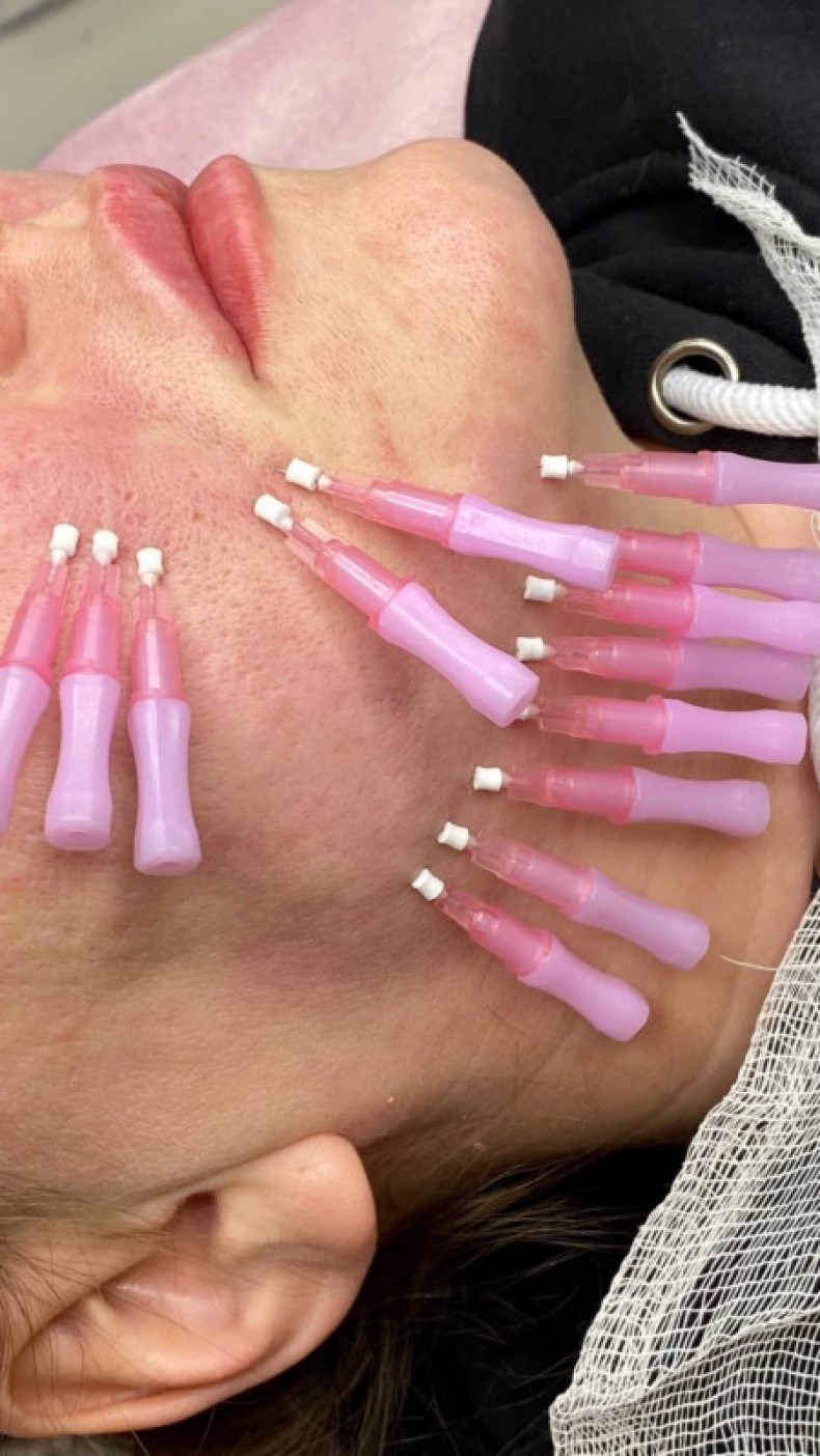 Тредліфтинг, фото - Лікар-косметолог Лілія Миколаївна