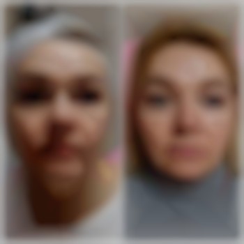 Контурна пластика