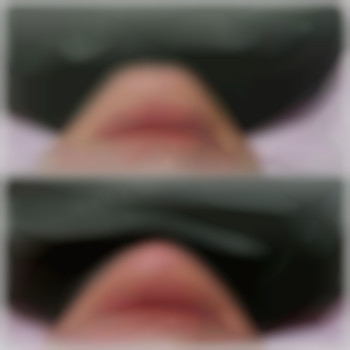 Корекція підборіддя, фото - лікар-косметолог Лілія Миколаївна