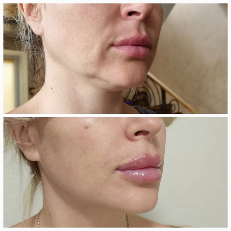 Тредліфтинг+колагенотерапія
 #тредлифтинг
 #биоревитализация, фото - Лікар-косметолог Лілія Миколаївна