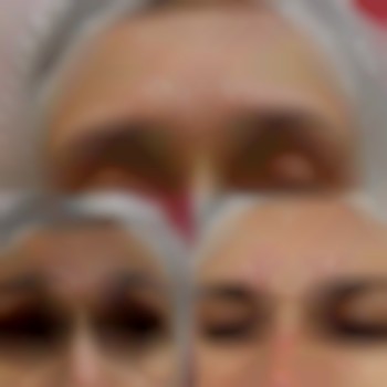 Ботокс верхньої третини обличчя