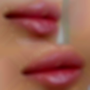 Збільшення губ
1 мл.