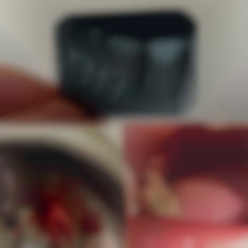 Видалення зубів
                    Стоматолог Іван Львів