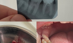 Видалення зубів Стоматолог Іван Львів