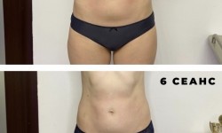 УЗ кавітація + масаж Косметолог-естетист Олеся Київ