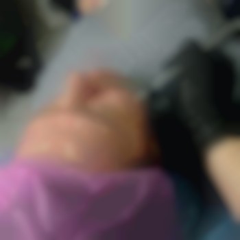 Усунення пігментних плям