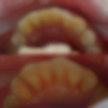 лікування пародонтиту лікар Аліна Анатоліївна район Озерна в стоматології VA Clinic .