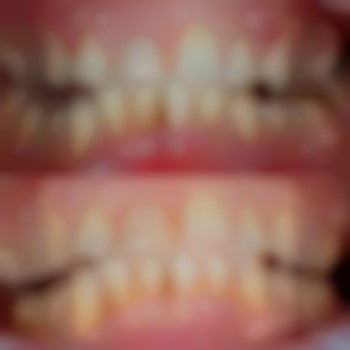 лікування пародонтиту в стоматології VA Clinic Аліна Анатоліївна  район Озерна.