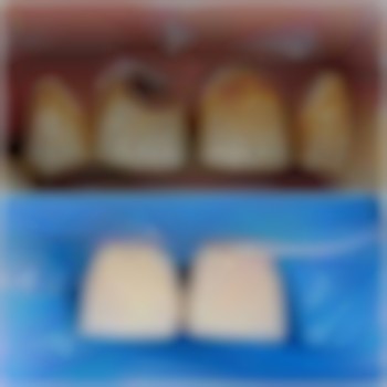 реставрація зубів в стоматології Хмельницький вулиця Панаса Мирного 18б