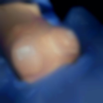 маммопластика, імпланти в груди