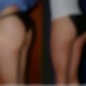 корекція фігури, масаж тіла, пластична операція тіла