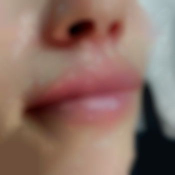 Увеличение губ