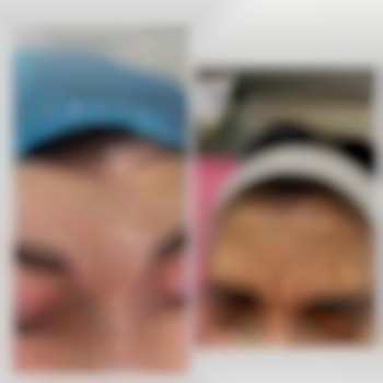 Ботокс до и после