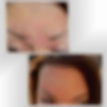 Ботокс до и после