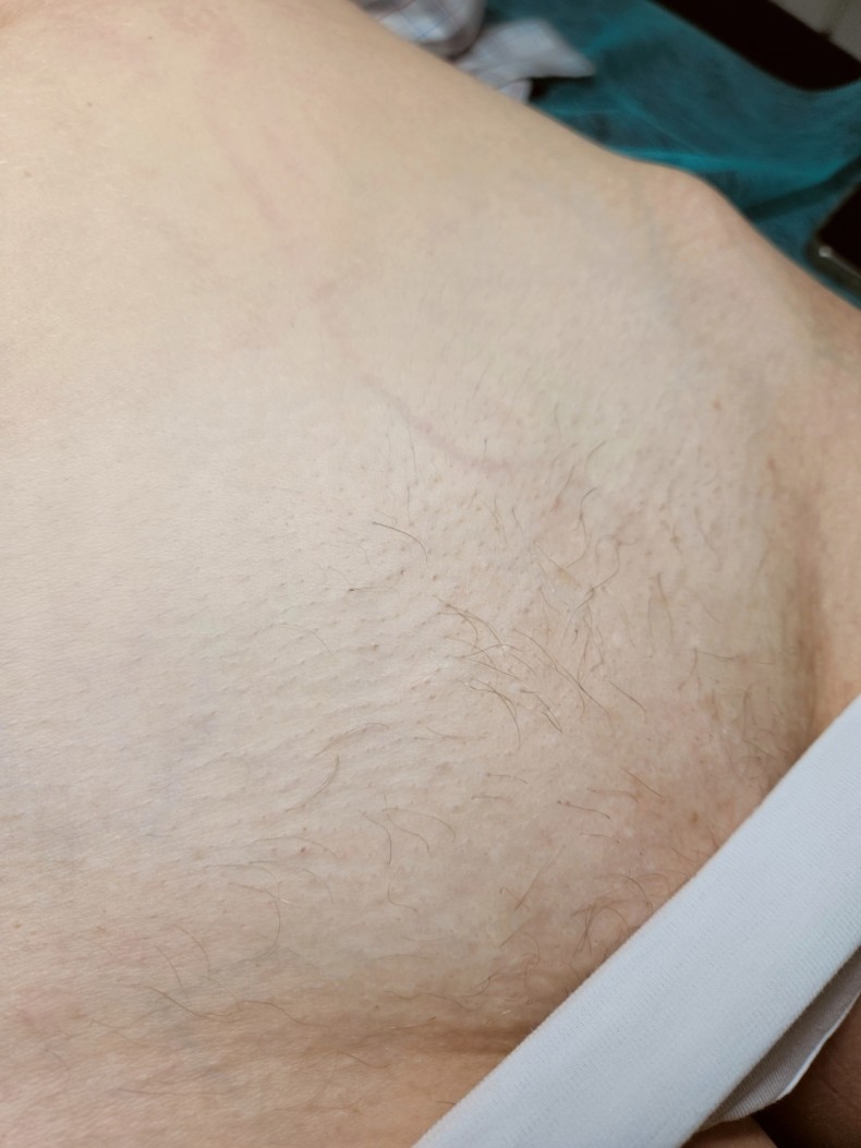 Через 2 місяці після 1 процедуры, АЛЕ це дуже гарна динаміка, і вона індивідуальна
Запам'ятайте лише одне, у кожного з нас є своя кількість фолікулів, і ростуть вони у всіх по різному
Зазвичай процедури з кожним проходом займають все менше часу, а ось наприклад цьому показую, шо 3я процедура буде довшою ніж 2, тому що збираємо побільше
Не привязуйтесь до часу, всеодно волосся закінчиться, просто не порівнюйте один з одним, фото - Салон краси Electro Studio