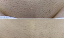 Лазерна епіляція гомілки + коліна Косметологічний центр Ендосфера центр Кременчук