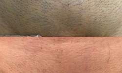 Lumenis Desire Лазерна епіляція коліна (жіночі) Косметологічний центр Ендосфера центр Кременчук