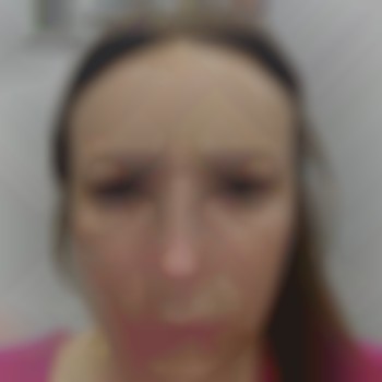 Ботокс чоло.