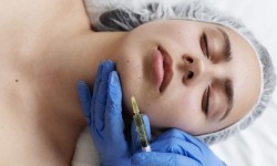 Куточки рота Рентокс Косметологічний центр Сфера Плюс Київ