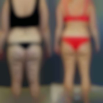 - 9 кг після закінчення курсу апаратної корекції «Тіло мрії» Максимум