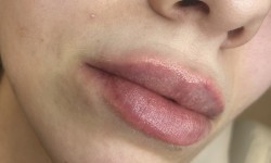 Збільшення губ Лікар-косметолог Андріана Львів