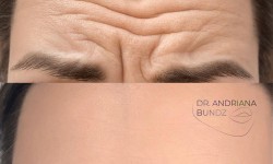Ботулінотерапія Лікар-косметолог Андріана Львів