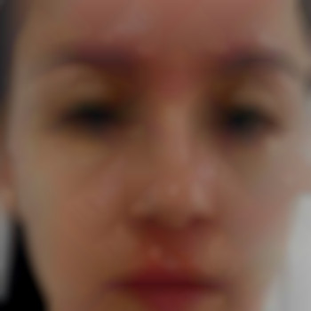 Відразу після процедури