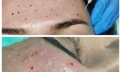 Мезотерапія, біоревіталізація, ліполітики Косметолог Виктория Харків