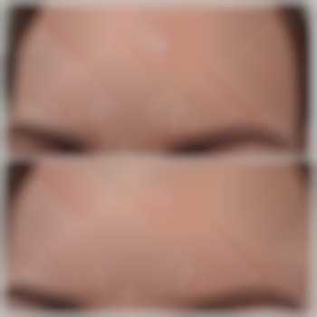 Корекція пігментних плям за допомогою мезококтейлю. Результат після трьох процедур.