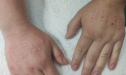 Біоревіталізація Косметолог Виктория Харків