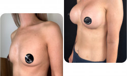 Збільшення грудей Пластичний хірург Алексей Київ