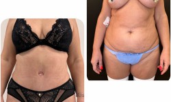 Абдомінопластика Пластичний хірург Алексей Київ