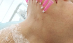 Тредліфтинг / нитковий ліфтинг Косметолог Світлана Івано-Франківськ