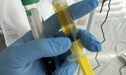 Плазмоліфтинг Косметолог Світлана Івано-Франківськ