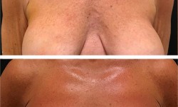 Мікроголковий РФ ліфтинг декольте Косметологічний центр  Ужгород