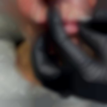 Корекція кісетних зморшок