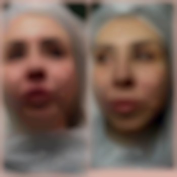 Зроблено корекцію носогубних заломів, підняття куточків губ, корекція нижньої третини обличчя