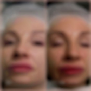 Зроблено наповнення об'єму губ