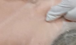 Сосудистый этап мезотерапии Косметолог Татьяна Київ