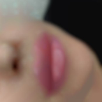 3мл філлера